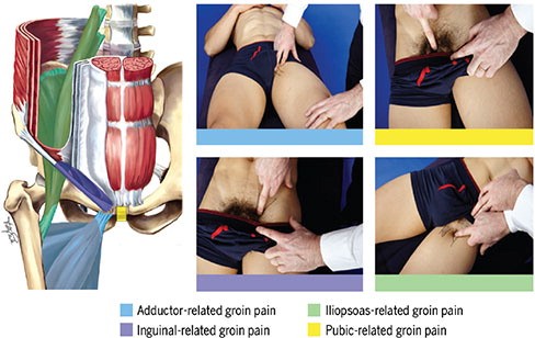 Athletic Groin Pain in Sport